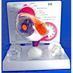 Eye Model w/ Cataracts