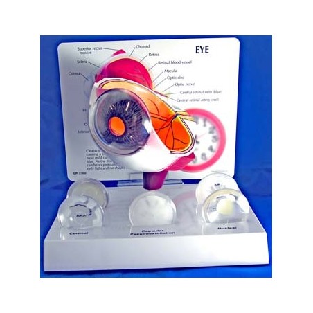 Eye Model w/ Cataracts