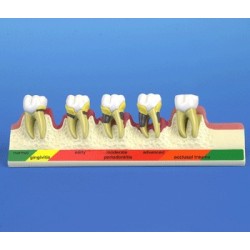 Periodontal Disease Stages Model
