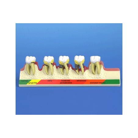 Periodontal Disease Stages Model