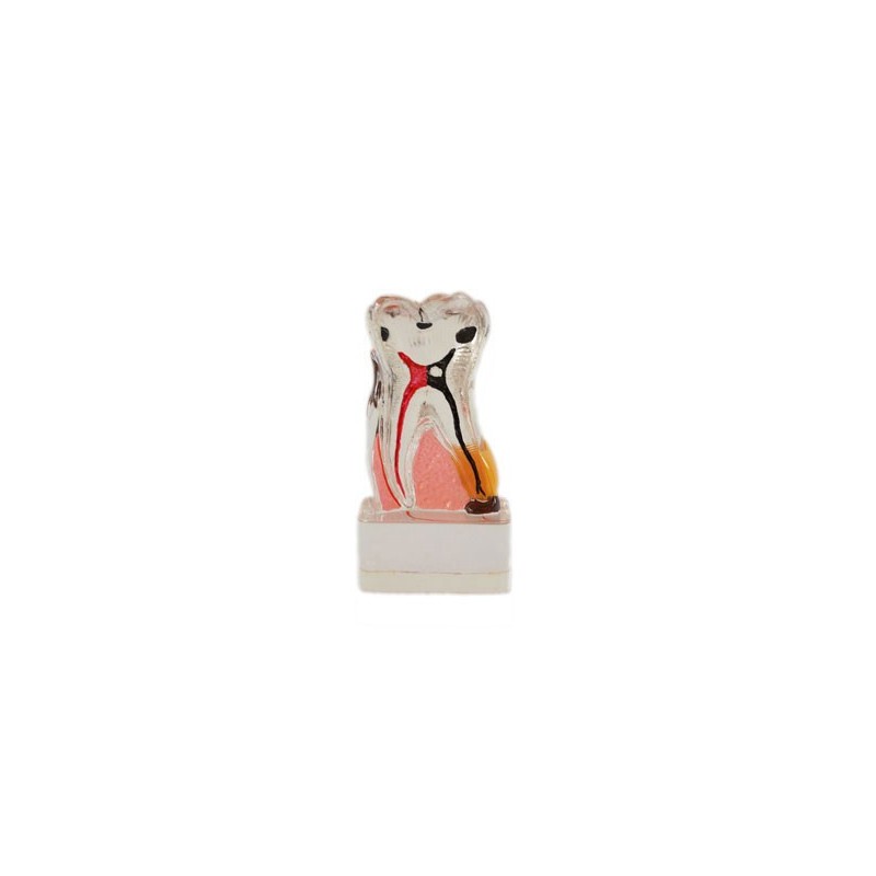 Pathological Molar Model