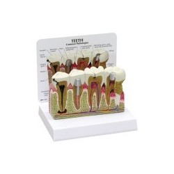 Molar Anatomy/Pathology Model