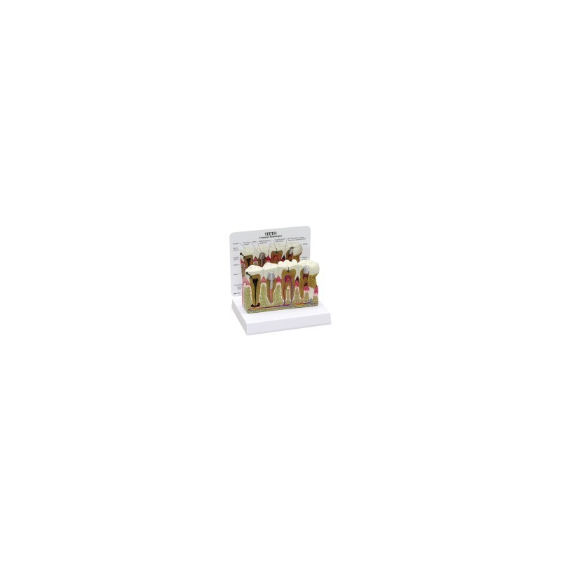 Molar Anatomy/Pathology Model