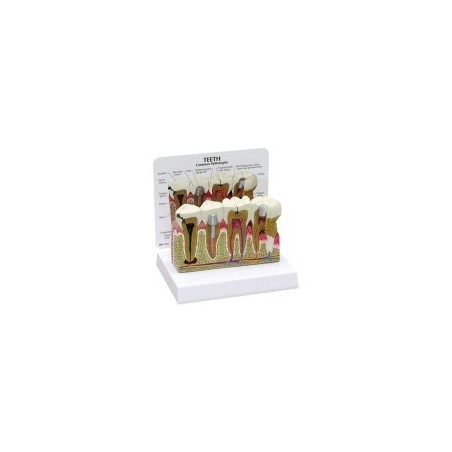 Molar Anatomy/Pathology Model